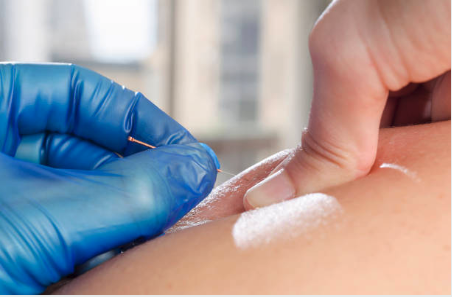 Acupuncture / Dry Needling